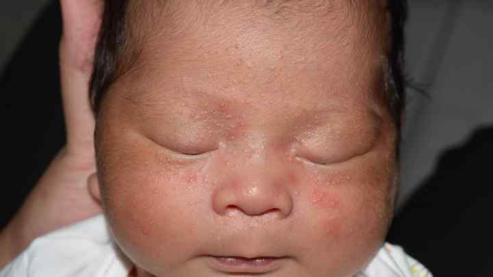 Як лікувати стафілокок у немовляти